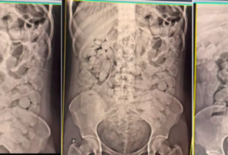 Mulheres são flagradas com cocaína no estômago durante abordagem a ônibus clandestino